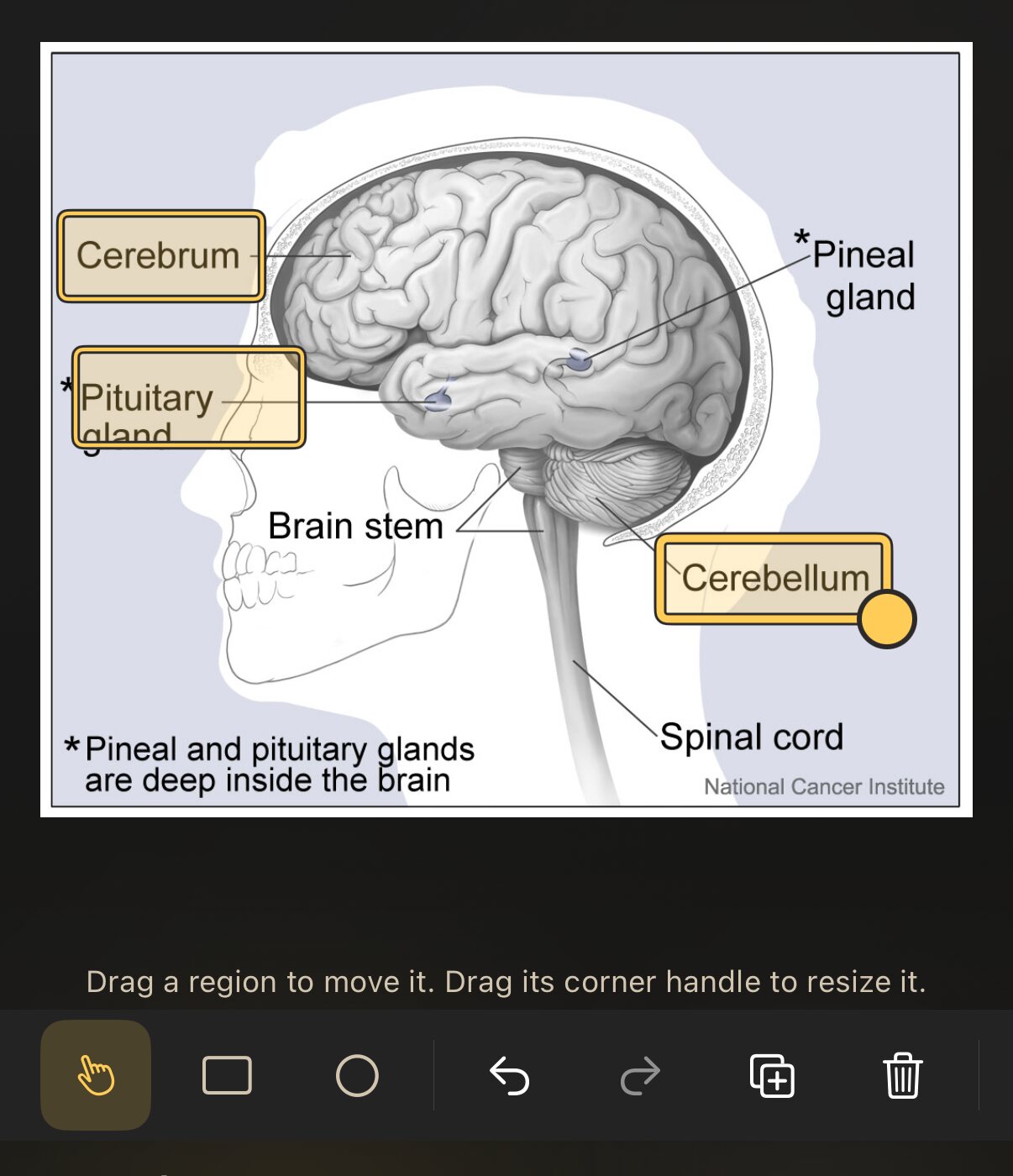 The occlusion editor: an anatomy diagram with rectangles drawn over the labels, and the tools row above.